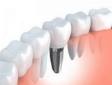 Dental Implants Thornton
