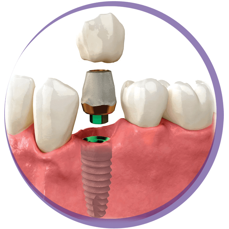 Dental Crowns Definition, Types and Procedure Involved