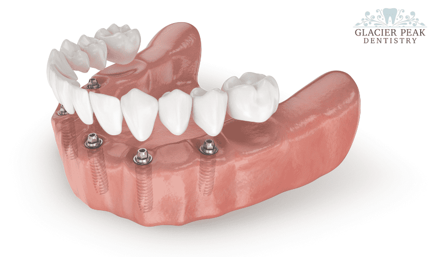 Dental Implants in Thornton