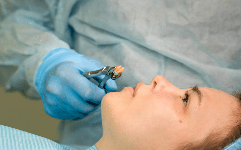 How to Clean Teeth After Wisdom Teeth Removal