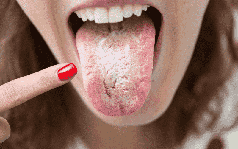 Dry Mouth