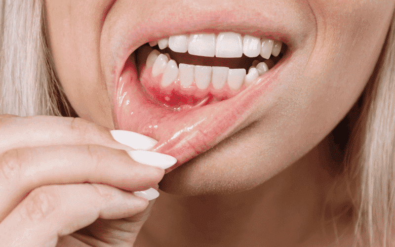 Gum Grafting