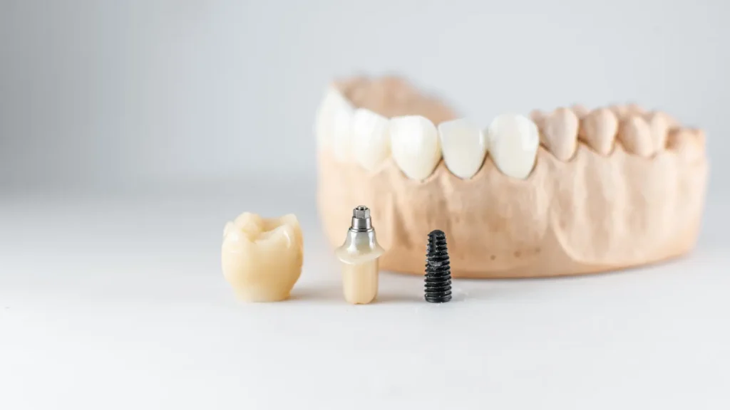 A Step-by-Step Guide to the Dental Implant Procedure in 2024