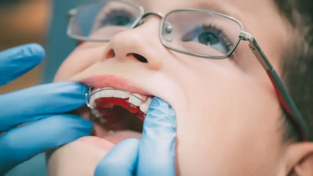 The Benefits Of Early Orthodontic Treatment For Children