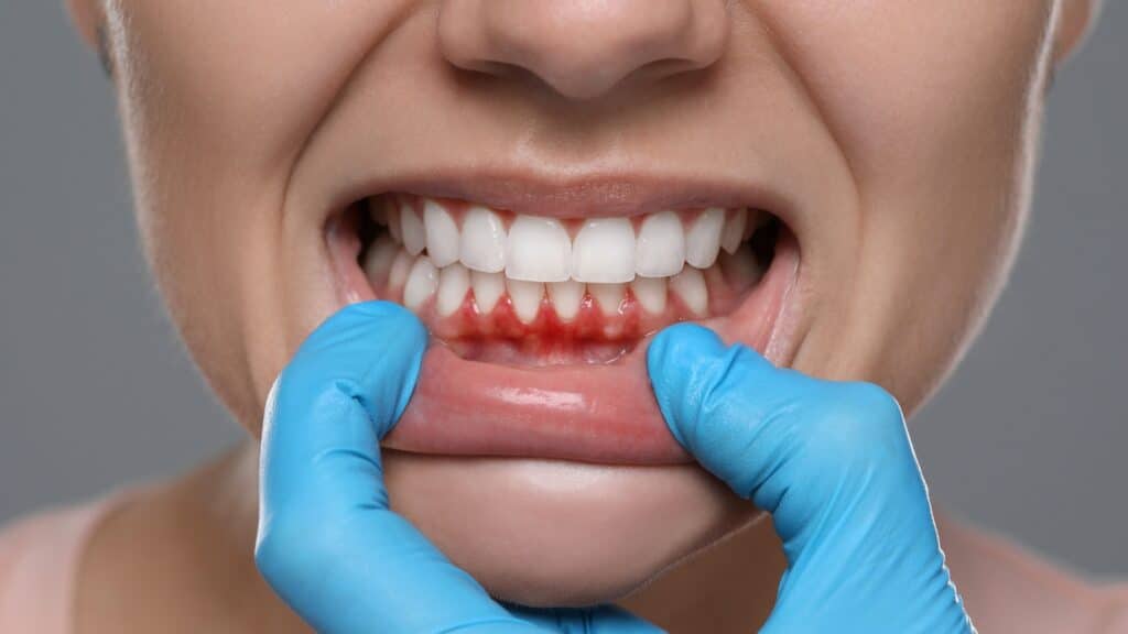 How Cosmetic Dentistry Can Help With Receding Gums